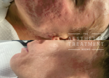 Improvement of Acne Scarring with microneedling and a chemical peel