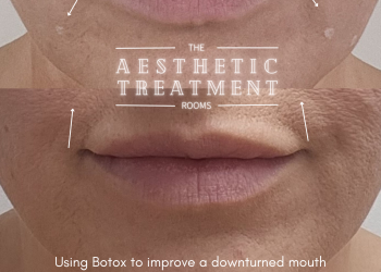 This treatment shows lifting of the corners of the mouth