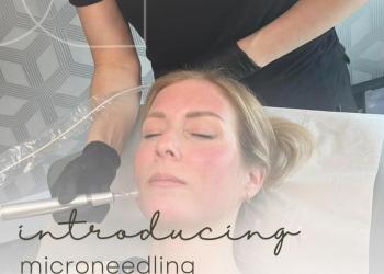 Microneedling treatment in action